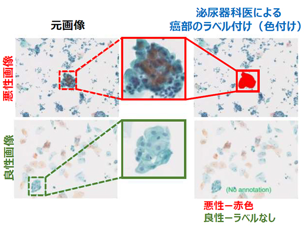 尿細胞診画像による、尿路上皮癌細胞の識別例